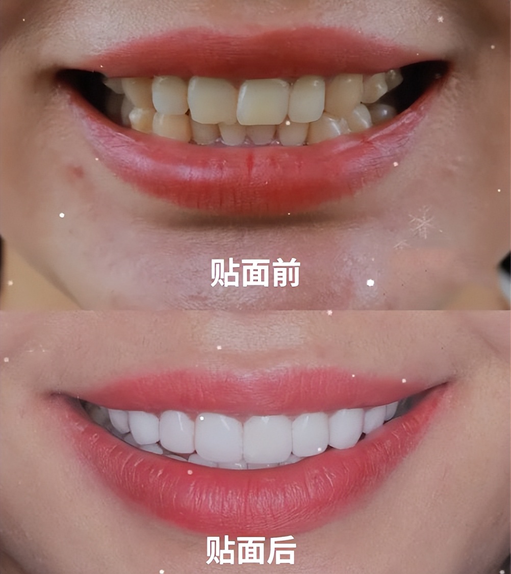 美牙这么火美容院的美牙贴面靠谱吗