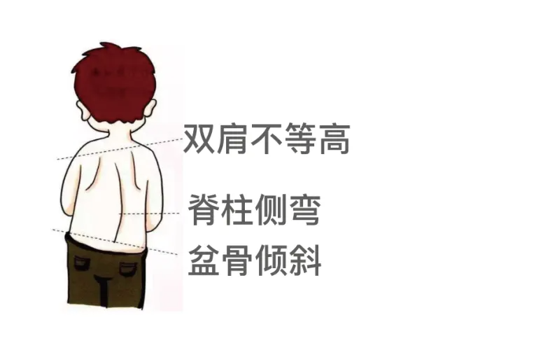 脊柱侧弯一般是小学五六年级开始发病,女生的发病率高于男生.